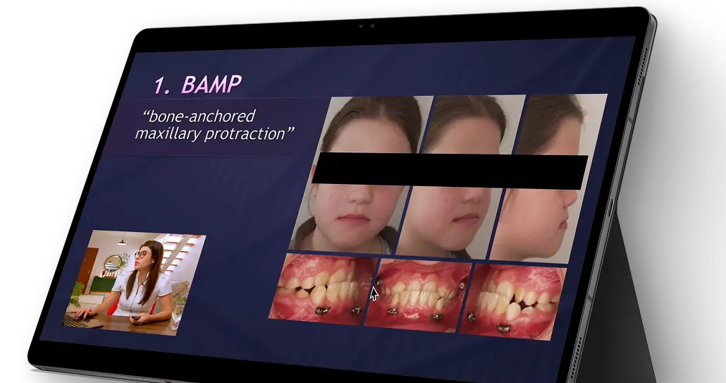 Clase sobre tratamiento ortopédico de la Clase III con mini-implantes